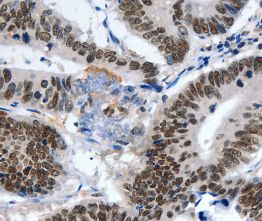 Immunohistochemistry of paraffin-embedded Human colon cancer tissue using LRP5 Polyclonal Antibody at dilution 1:55