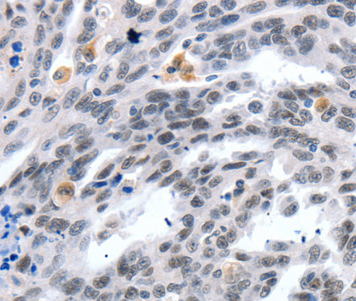 Immunohistochemistry of paraffin-embedded Human ovarian cancer tissue using LRP5 Polyclonal Antibody at dilution 1:55