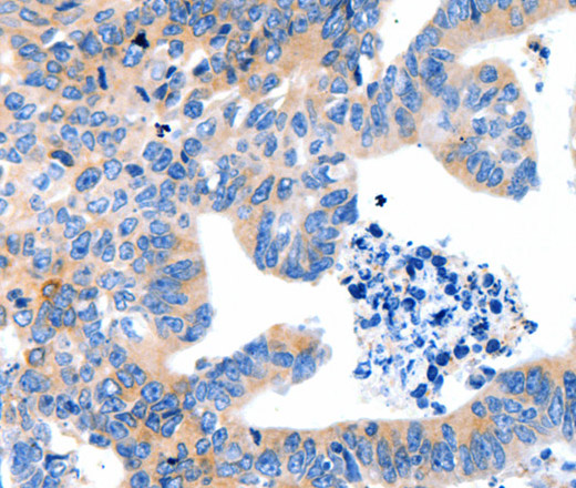 Immunohistochemistry of paraffin-embedded Human colon cancer using LRPAP1 Polyclonal Antibody at dilution of 1:100