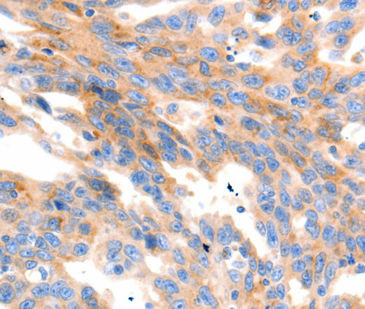 Immunohistochemistry of paraffin-embedded Human ovarian cancer using MAP2K2 Polyclonal Antibody at dilution of 1:100