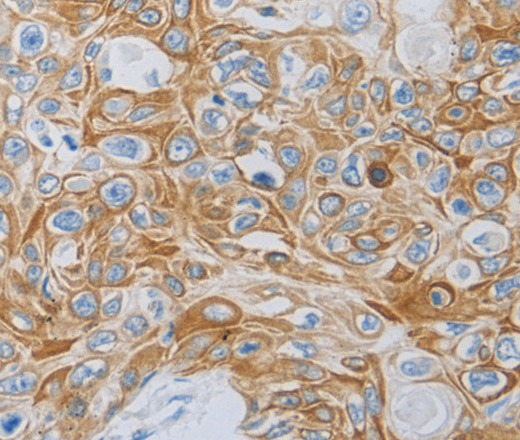 Immunohistochemistry of paraffin-embedded Human esophagus cancer tissue using MC5R Polyclonal Antibody at dilution 1:60