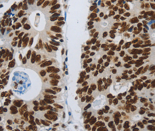 Immunohistochemistry of paraffin-embedded Human colon cancer tissue using SLC16A14 Polyclonal Antibody at dilution 1:80