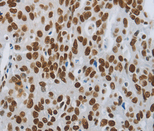 Immunohistochemistry of paraffin-embedded Human ovarian cancer tissue using SLC16A14 Polyclonal Antibody at dilution 1:80