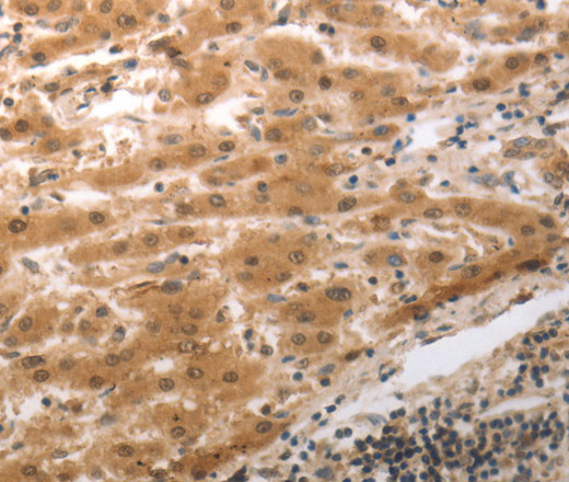 Immunohistochemistry of paraffin-embedded Human liver cancer using MMP27 Polyclonal Antibody at dilution of 1:40