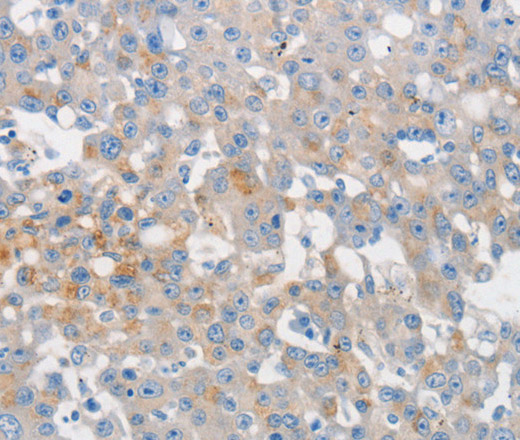 Immunohistochemistry of paraffin-embedded Human breast cancer tissue using MUC5AC Polyclonal Antibody at dilution 1:80