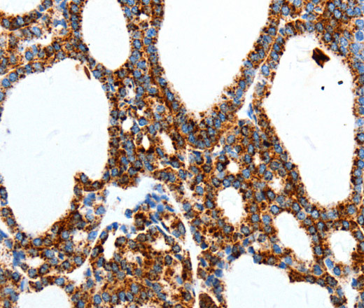 Immunohistochemistry of paraffin-embedded Human thyroid cancer using MTNR1A Polyclonal Antibody at dilution of 1:40