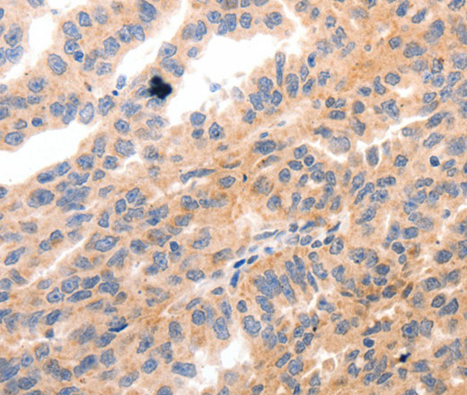 Immunohistochemistry of paraffin-embedded Human ovarian cancer using MYL9 Polyclonal Antibody at dilution of 1:80