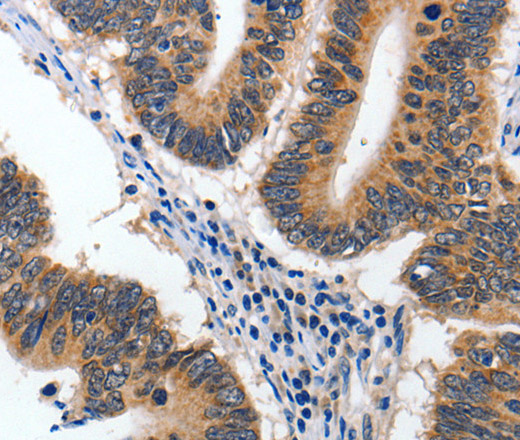 Immunohistochemistry of paraffin-embedded Human colon cancer using 14-3-3 epsilon Polyclonal Antibody at dilution of 1:60