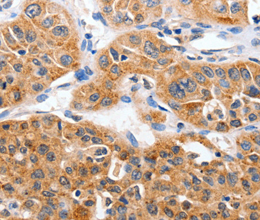 Immunohistochemistry of paraffin-embedded Human lung cancer using YWHAG Polyclonal Antibody at dilution of 1:50