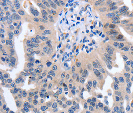 Immunohistochemistry of paraffin-embedded Human ovarian cancer using 14-3-3 theta Polyclonal Antibody at dilution of 1:50