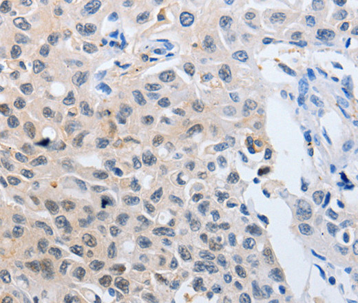 Immunohistochemistry of paraffin-embedded Human lung cancer using 14-3-3 theta Polyclonal Antibody at dilution of 1:50