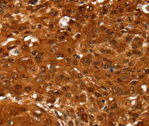 Immunohistochemistry of paraffin-embedded Human cervical cancer tissue using NCOR1 Polyclonal Antibody at dilution 1:60