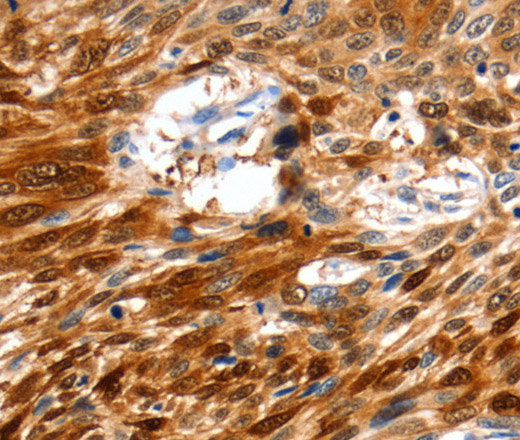 Immunohistochemistry of paraffin-embedded Human esophagus cancer tissue using NCOR1 Polyclonal Antibody at dilution 1:60