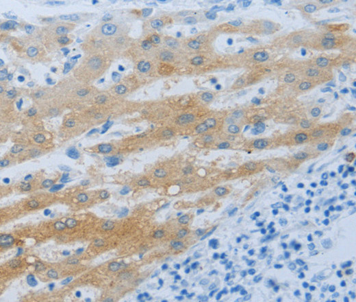 Immunohistochemistry of paraffin-embedded Human liver cancer using NPHS1 Polyclonal Antibody at dilution of 1:50