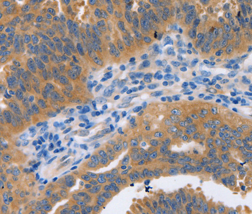 Immunohistochemistry of paraffin-embedded Human ovarian cancer tissue using NBEA Polyclonal Antibody at dilution 1:60