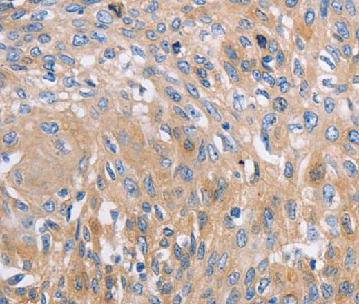 Immunohistochemistry of paraffin-embedded Human cervical cancer tissue using NBEA Polyclonal Antibody at dilution 1:60