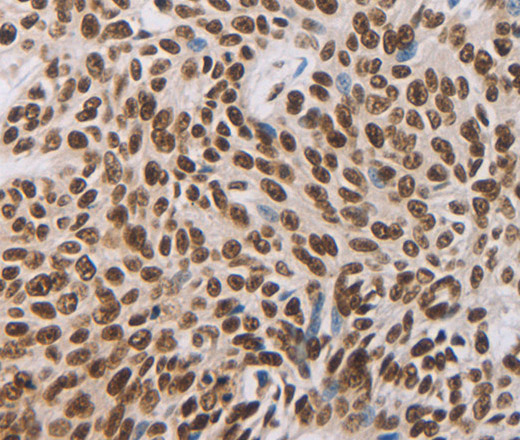 Immunohistochemistry of paraffin-embedded Human esophagus cancer using AKAP8 Polyclonal Antibody at dilution of 1:30