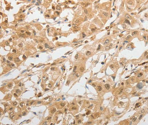 Immunohistochemistry of paraffin-embedded Human lung cancer tissue using GRIN2C Polyclonal Antibody at dilution 1:100