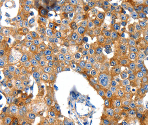 Immunohistochemistry of paraffin-embedded Human breast cancer tissue using GluR2 Polyclonal Antibody at dilution 1:40