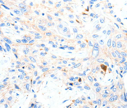 Immunohistochemistry of paraffin-embedded Human esophagus cancer tissue using P2RY1 Polyclonal Antibody at dilution 1:50