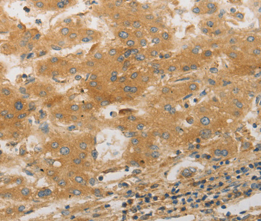 Immunohistochemistry of paraffin-embedded Human liver cancer tissue using PLPP1 Polyclonal Antibody at dilution 1:50