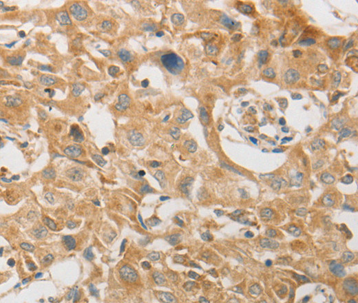 Immunohistochemistry of paraffin-embedded Human lung cancer tissue using PLPP1 Polyclonal Antibody at dilution 1:50