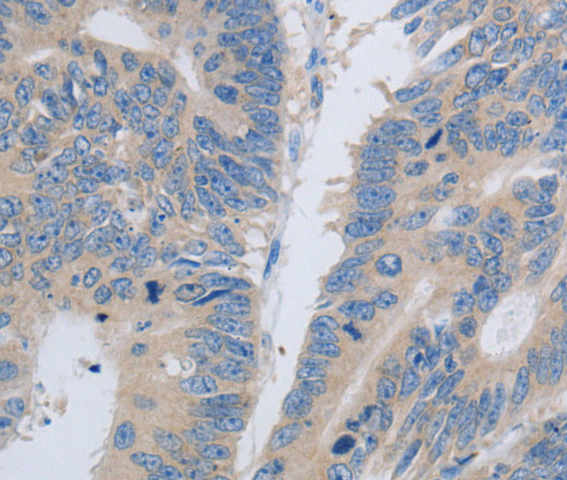 Immunohistochemistry of paraffin-embedded Human colon cancer using PAWR Polyclonal Antibody at dilution of 1:60