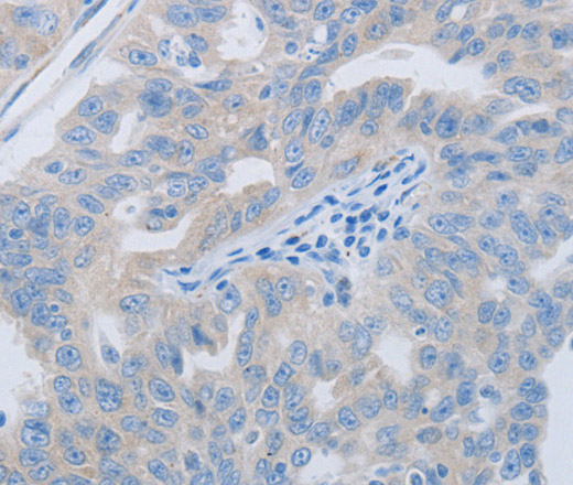 Immunohistochemistry of paraffin-embedded Human ovarian cancer using PAWR Polyclonal Antibody at dilution of 1:60