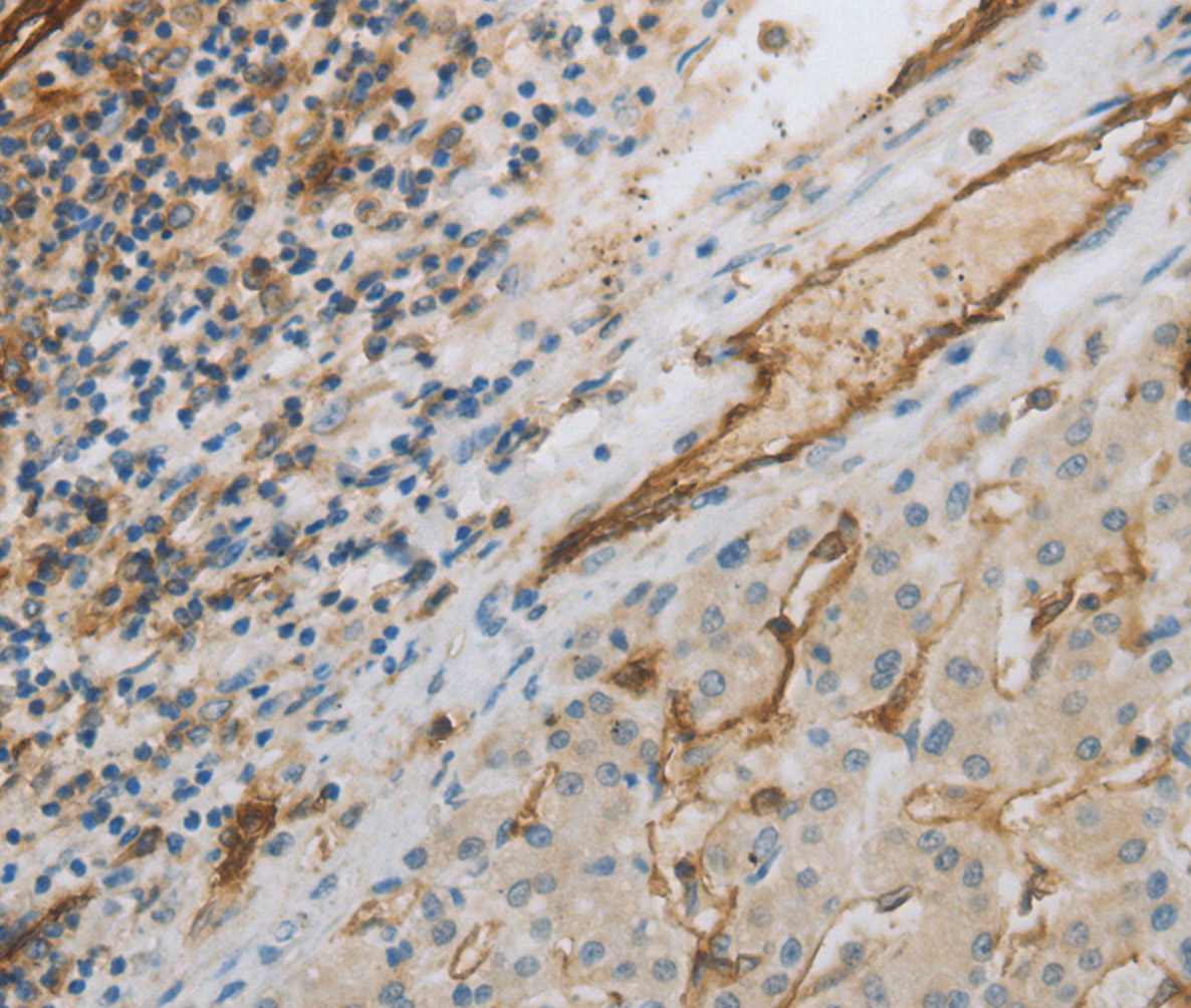 Immunohistochemistry of paraffin-embedded Human liver cancer using CD31 Polyclonal Antibody at dilution of 1:30