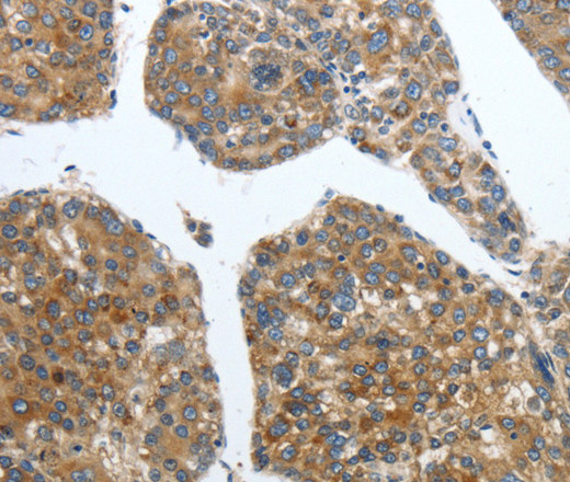 Immunohistochemistry of paraffin-embedded Human liver cancer using PDK2 Polyclonal Antibody at dilution of 1:40