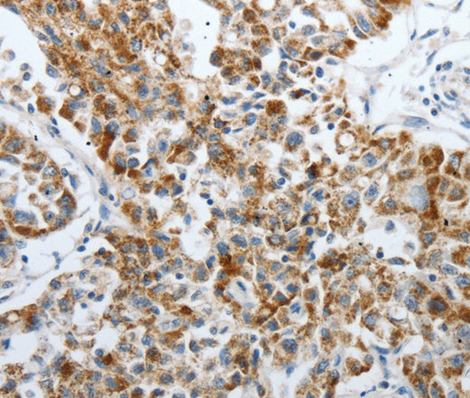 Immunohistochemistry of paraffin-embedded Human lung cancer using PDK2 Polyclonal Antibody at dilution of 1:40