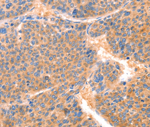 Immunohistochemistry of paraffin-embedded Human liver cancer using PRDX2 Polyclonal Antibody at dilution of 1:80