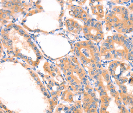 Immunohistochemistry of paraffin-embedded Human thyroid cancer using PRDX2 Polyclonal Antibody at dilution of 1:80