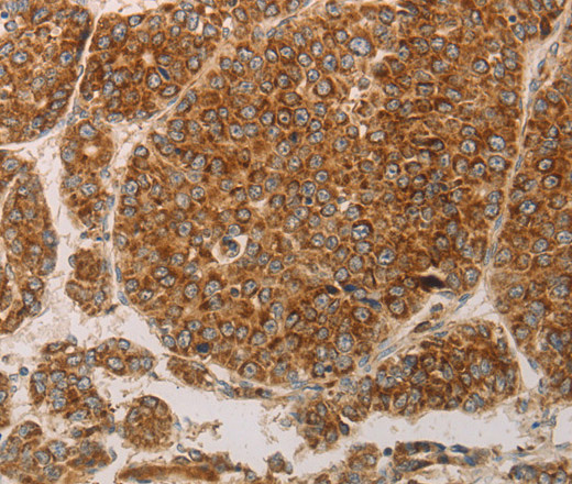 Immunohistochemistry of paraffin-embedded Human liver cancer using PRDX3 Polyclonal Antibody at dilution of 1:50