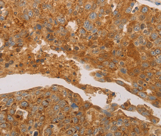 Immunohistochemistry of paraffin-embedded Human ovarian cancer using PRDX3 Polyclonal Antibody at dilution of 1:50