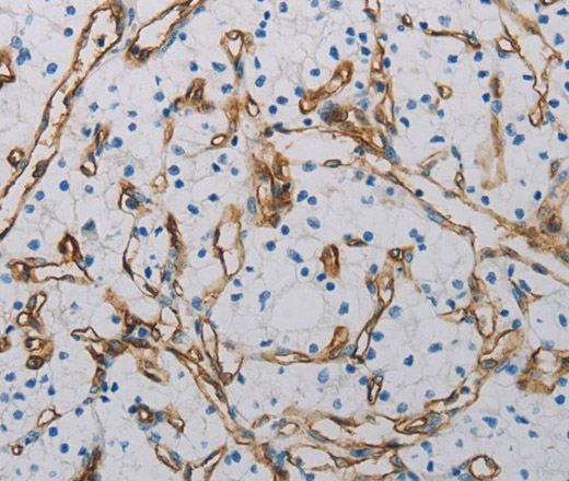 Immunohistochemistry of paraffin-embedded Human renal cancer tissue using CD31 Polyclonal Antibody at dilution 1:40