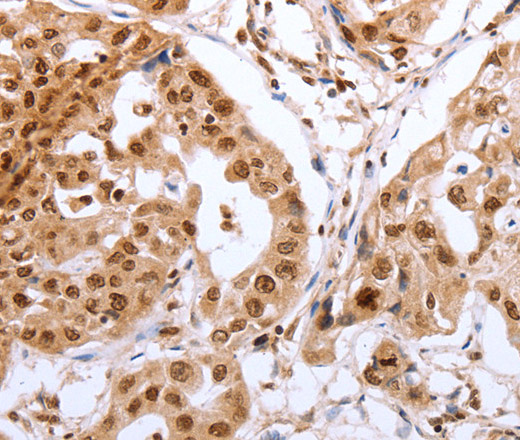 Immunohistochemistry of paraffin-embedded Human lung cancer tissue using PTTG1 Polyclonal Antibody at dilution 1:60