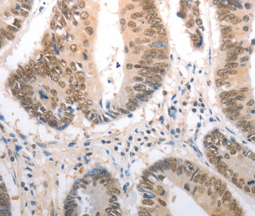 Immunohistochemistry of paraffin-embedded Human colon cancer using RAD50 Polyclonal Antibody at dilution of 1:40