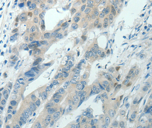 Immunohistochemistry of paraffin-embedded Human colon cancer using RNF126 Polyclonal Antibody at dilution of 1:70