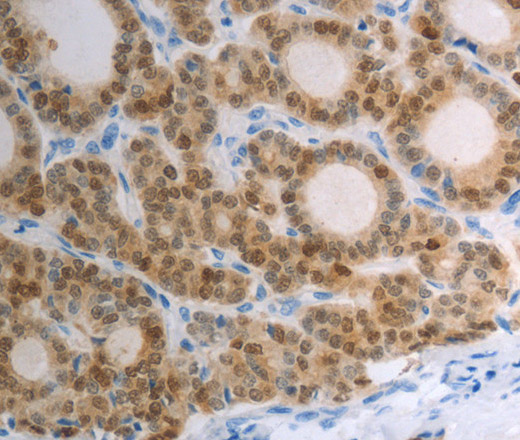 Immunohistochemistry of paraffin-embedded Human thyroid cancer tissue using S100A1 Polyclonal Antibody at dilution 1:40