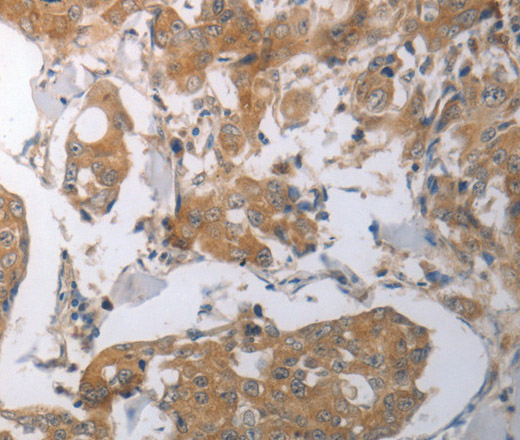 Immunohistochemistry of paraffin-embedded Human breast cancer tissue using SHH Polyclonal Antibody at dilution 1:70