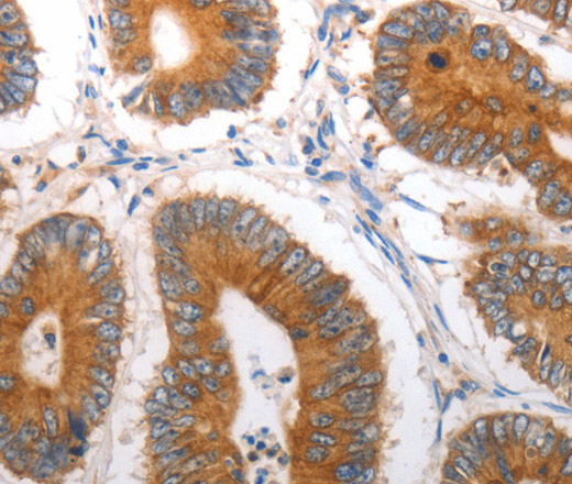 Immunohistochemistry of paraffin-embedded Human colon cancer tissue using SLC12A6 Polyclonal Antibody at dilution 1:40