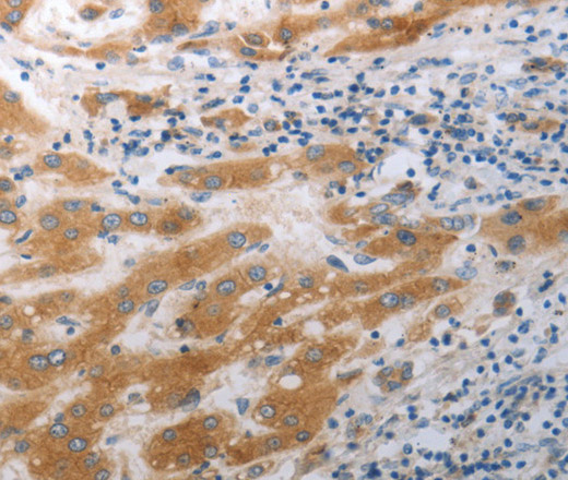 Immunohistochemistry of paraffin-embedded Human liver cancer tissue using SLC12A6 Polyclonal Antibody at dilution 1:40