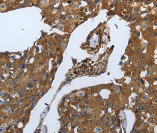 Immunohistochemistry of paraffin-embedded Human breast cancer tissue using SLC34A2 Polyclonal Antibody at dilution of 1:70