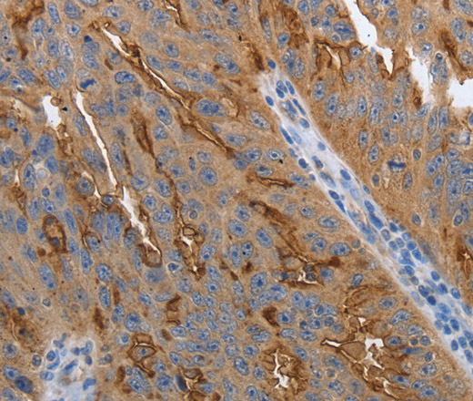 Immunohistochemistry of paraffin-embedded Human ovarian cancer using SLC34A2 Polyclonal Antibody at dilution of 1:70