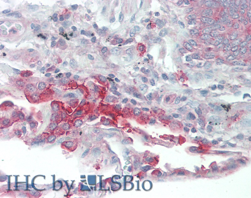 Immunohistochemistry of paraffin-embedded Human Lung tissue using SLC34A2 Polyclonal Antibody at dilution of 1:60.