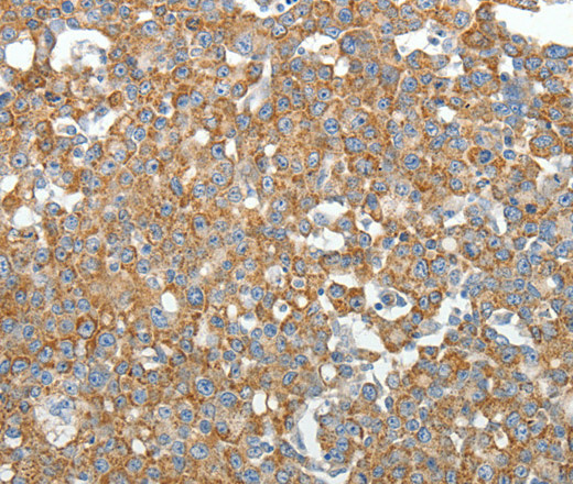 Immunohistochemistry of paraffin-embedded Human breast cancer tissue using GEMIN2 Polyclonal Antibody at dilution 1:40