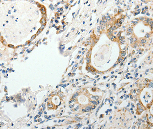 Immunohistochemistry of paraffin-embedded Human gastric cancer tissue using GEMIN2 Polyclonal Antibody at dilution 1:40