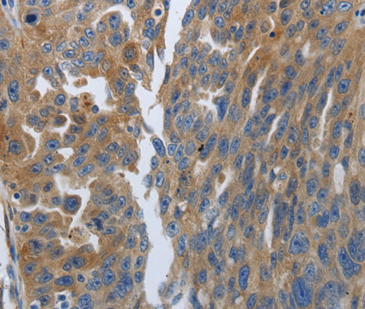 Immunohistochemistry of paraffin-embedded Human ovarian cancer using SOCS1 Polyclonal Antibody at dilution of 1:70