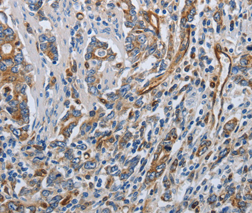 Immunohistochemistry of paraffin-embedded Human gastric cancer using SOCS1 Polyclonal Antibody at dilution of 1:70